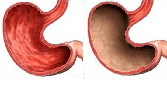 Ulcer, gastritis, cancer and other pathologies of the stomach (on the right), the occurrence of which was caused by alcohol
